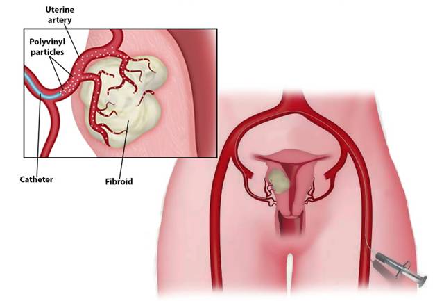 Post Surgical Instructions (UFE and Varicose Vein Surgery)