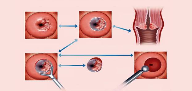 (H&igrave;nh 2 - M&ocirc; phỏng kho&eacute;t ch&oacute;p cổ tử cung cho bệnh nh&acirc;n ung thư cổ tử cung)